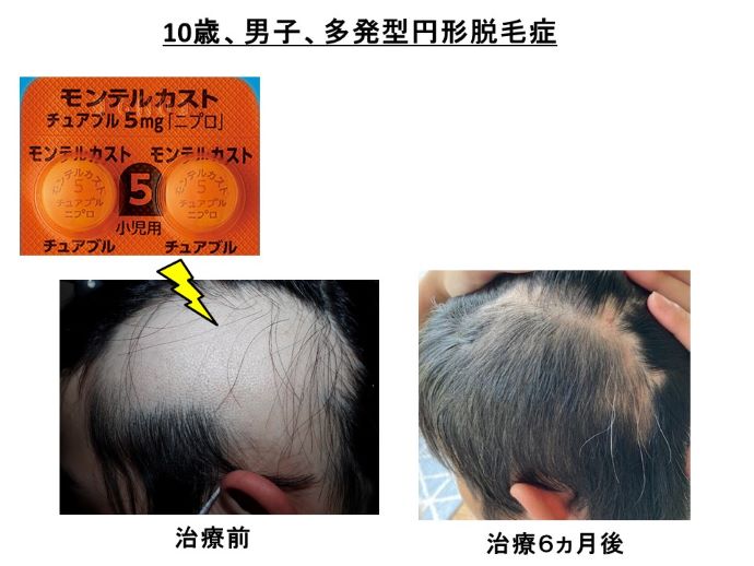 円形脱毛症　病院